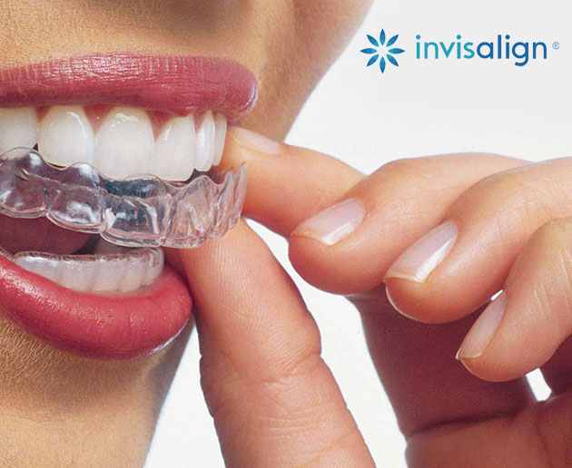 Smiling woman showcasing Invisalign teeth straightening treatment.