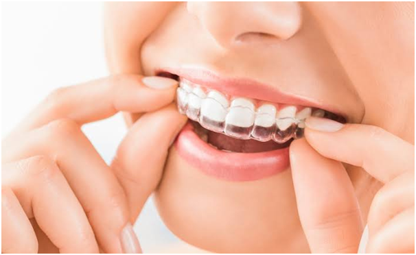 Invisalign Braces in Indore at Best cost - Dr. Virag Bhatia