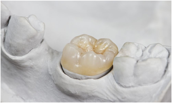 Two teeth with dental crowns, showcasing the best cosmetic dentistry in Indore.