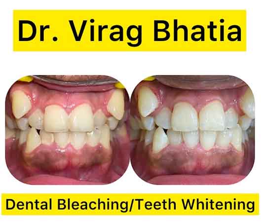 A tooth being treated for whitening at the Best Cosmetic Dentistry in Indore.
