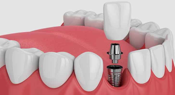 Dental implant showcasing a tooth, part of Dental Implants Treatment in Indore.